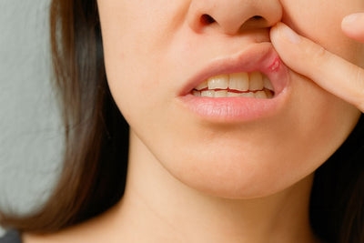 Aphten im Mund: Ursachen, Symptome & die besten Behandlungsmethoden